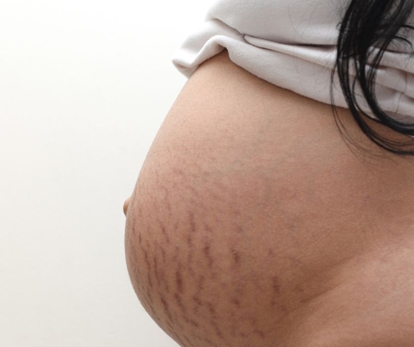 pregnant belly with stretch marks on her skin
