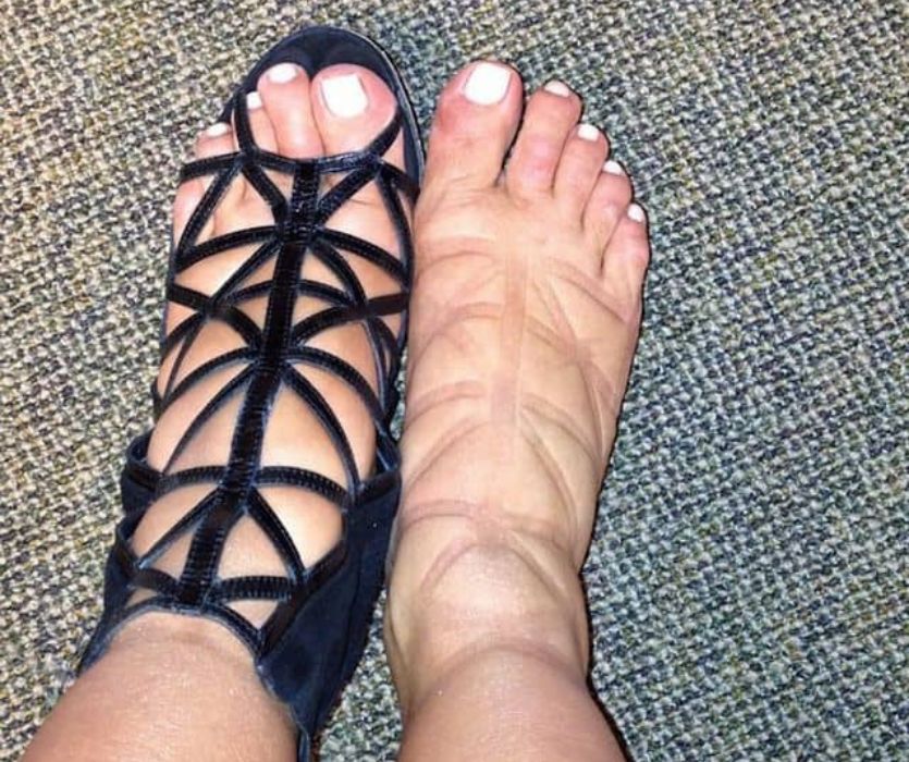 pregnancy feet in summer sandals