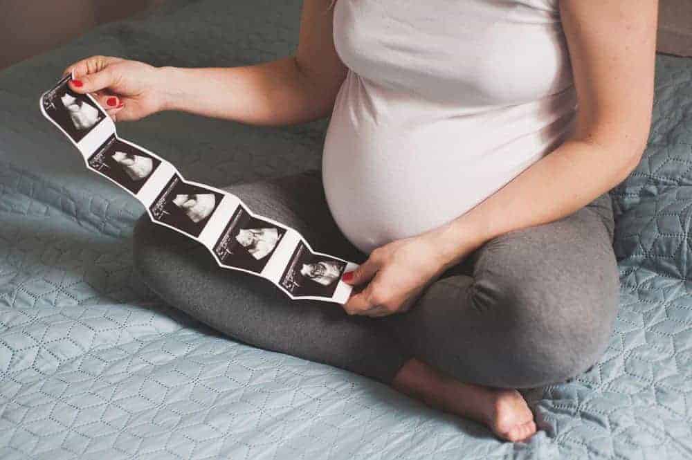 My Experience with Choroid Plexus Cysts